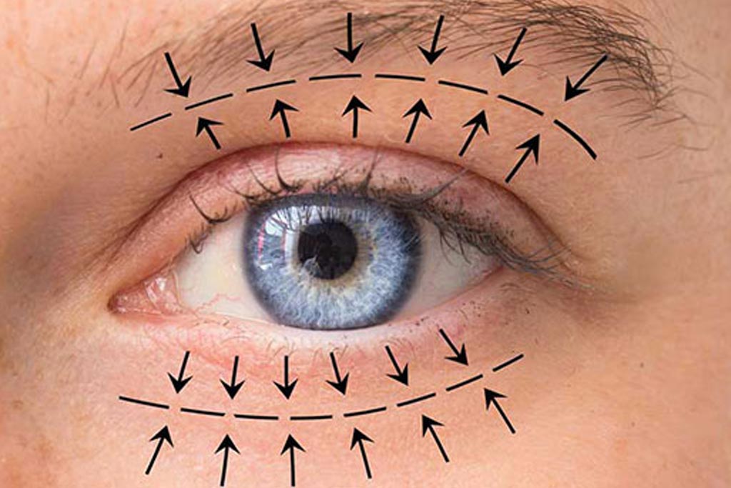 Eyelid Surgery